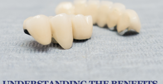 Understanding the Benefits of Crowns and Bridges